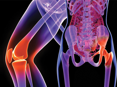 Hip and Knee Joint Replacement